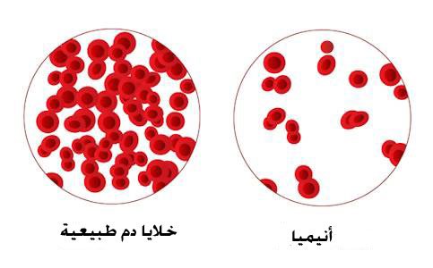 أعراض فقر الدم الشائعة