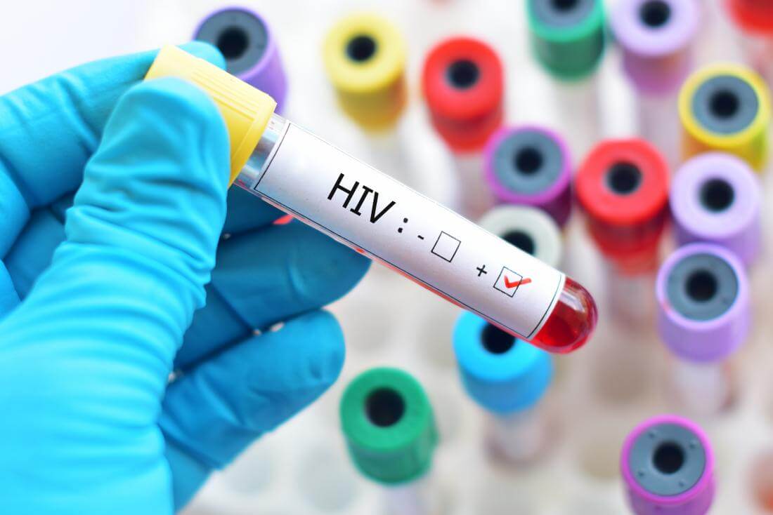 فوائد تحليل hiv.. وما هي أهميته؟