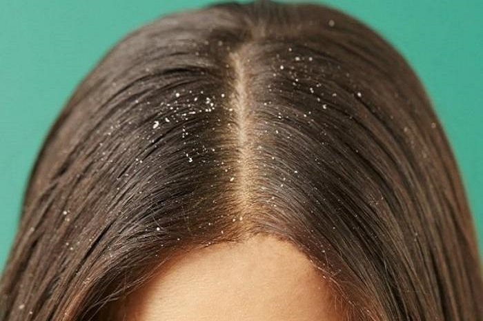 كيفية ازالة القشرة من الشعر