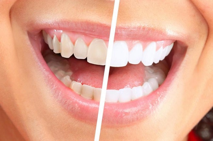 علاج طبيعي لتبييض الاسنان