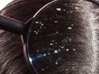 هل اكزيما الشعر مرض مزمن