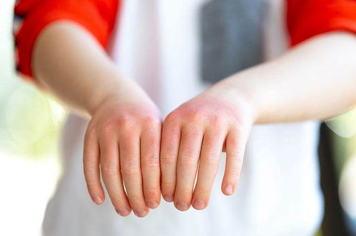 ما هو علاج الاكزيما اليدين
