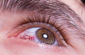 كيفية الوقاية من التهابات العين الشائعة أثناء الرياح الموسمية - اليوم السابع
