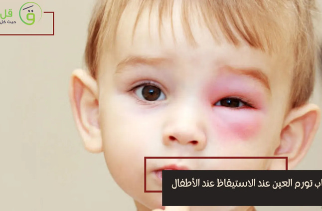 أسباب تورم العين عند الاستيقاظ عند الأطفال | قل ودل