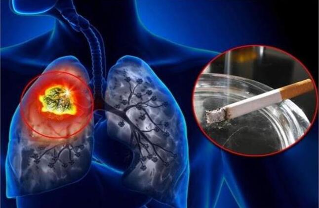 التدخين المسبب الأساسي لسرطان الرئة 