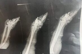 إعادة كف يد شاب مبتورة للحركة بعد عملية جراحية ناجحة في مستشفيات جامعة المنوفية