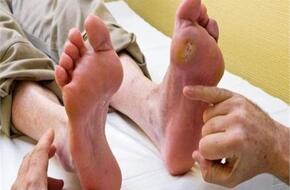 جراح مناظير عام: مرضى السكري أكثر الأشخاص عرضه لتقرح القدم