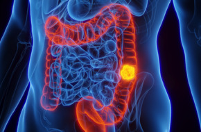 دراسة تحدد شكل الجسم الذي يزيد خطر الإصابة بسرطان القولون