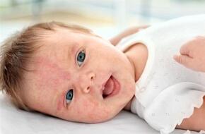 تعرف على أعراض حساسية الحليب الأكثر شيوعا عند الاطفال