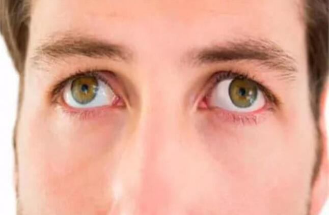 التغلب على رأرأة العين.. استراتيجيات فعالة لعلاج الاضطراب البصري