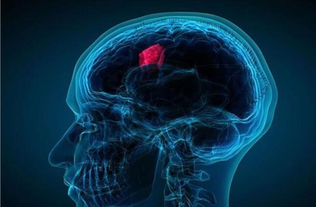 4 معلومات خاطئة عن أورام المخ.. تعرف عليها