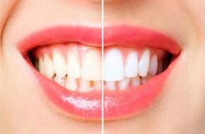 لابتسامة صحية ومشرقة.. 4 علاجات لأسنان بيضاء