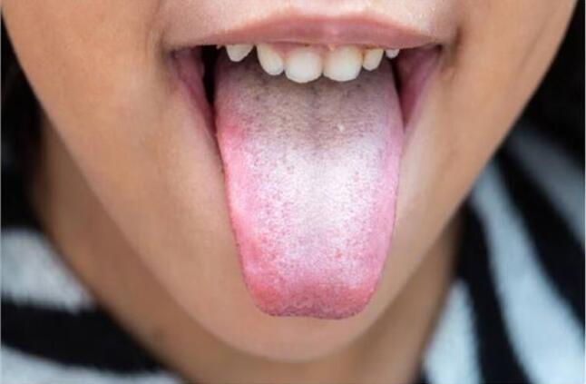 عدوى فطرية تصيب الفم| مرض القلاع الفموي.. الأسباب وطرق العلاج