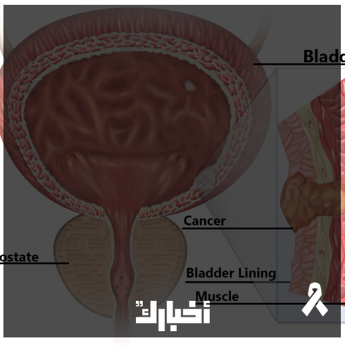 يعتبر سرطان المثانة بمثابة الورم الرابع من حيث نسبة الانتشار لدى الرجال، والثامن لدى النساء، لدى قرابة 80% من المرضى، يتم اكتشاف ورم سطحي لا يخترق عضلات المثانة، بينما لدى 20% يتم اكتشاف سرطان المثانة في مراحل متقدمة